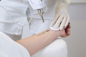 rimozione tatuaggi con il laser a picosecondi